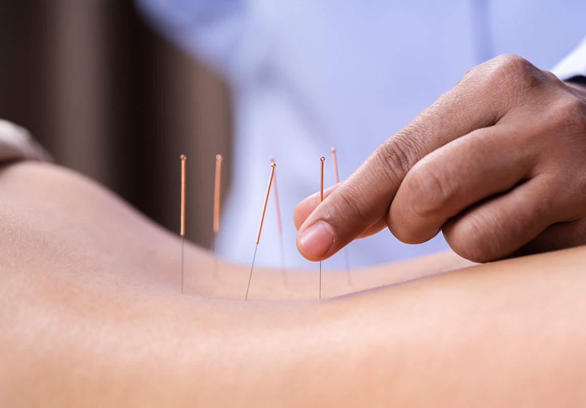 Acupuncture